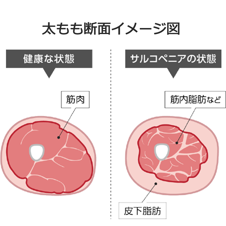 太もも断面イメージ図(健康な状態とサルコペニアの状態の比較)